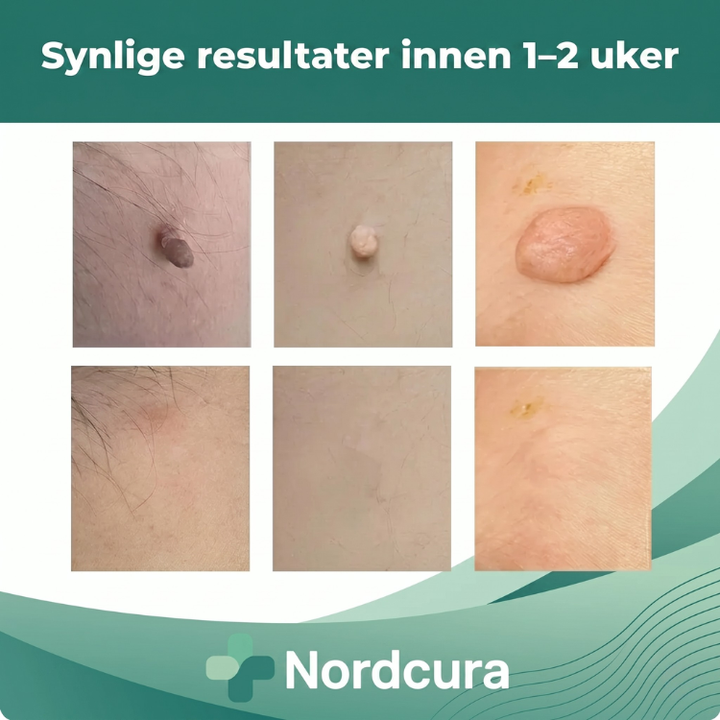 Enkelt hudflikfjerner sett for hjemmebruk. Inkluderer alt for rask og trygg fjerning av hudfliker.
