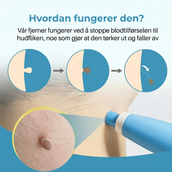 Effektiv hudflikfjerner for hjemmebruk. Løsning for enkel og trygg fjerning av uønskede hudfliker.