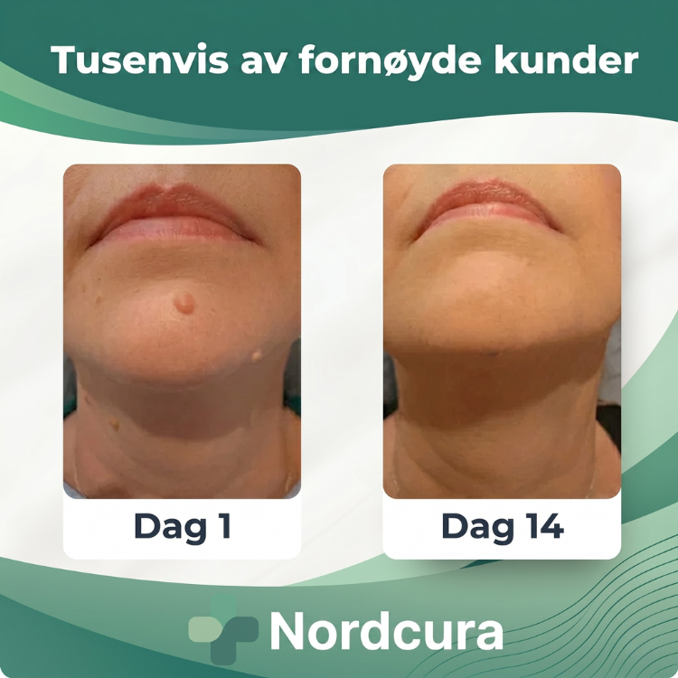 Praktisk hudpleiesett med hudflikfjerner for enkel og trygg fjerning. Oppnå glattere hud hjemme.