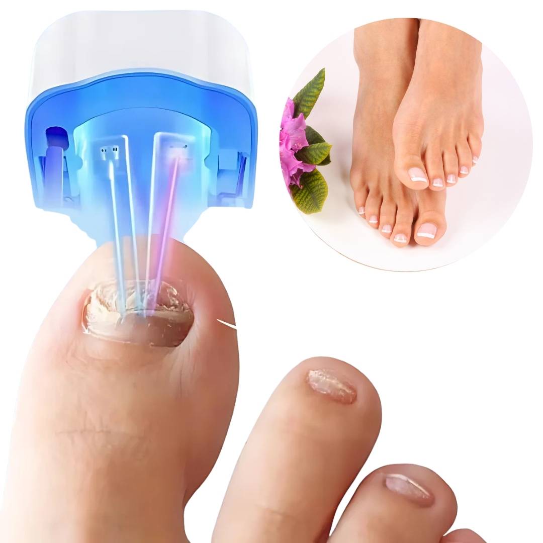Effektiv Neglesopp Laser: Smertefri Hjemmebehandling